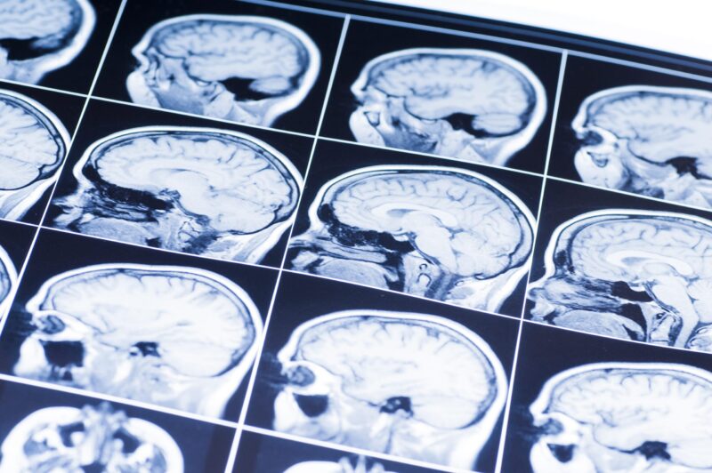 Can I Sue My Child’s School For A Brain Injury?